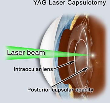 capsulotomy 1.jpg